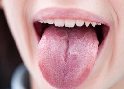 درمان سریع تاول زبان با چند راه چاره خانگی