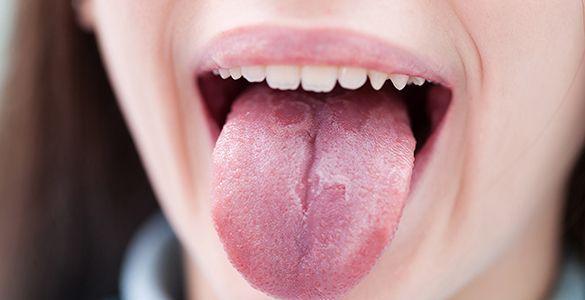 درمان سریع تاول زبان با چند راه چاره خانگی